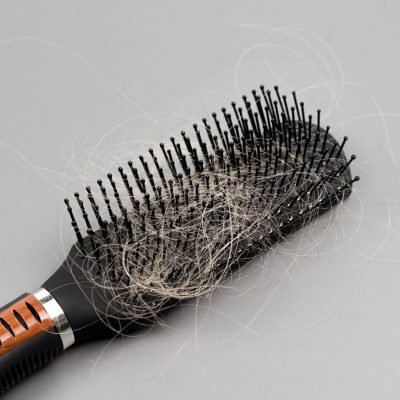 Hair,Loss,Problem,,Hairbrush,With,A,Lot,Of,Fallen,Hairs